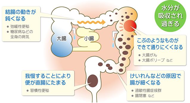 便秘の仕組み