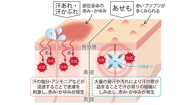 あせかぶれ