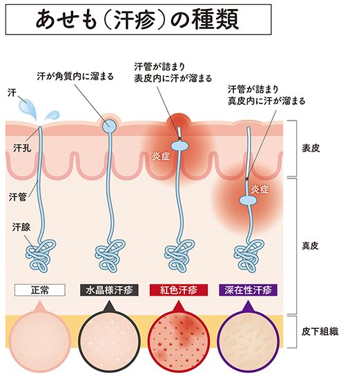 あせも