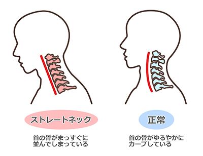 ぎっくり首