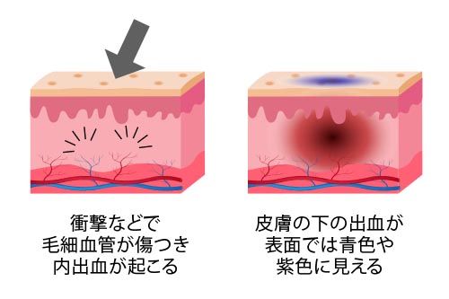 内出血