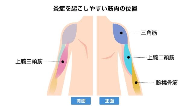 炎症を起こしやすい