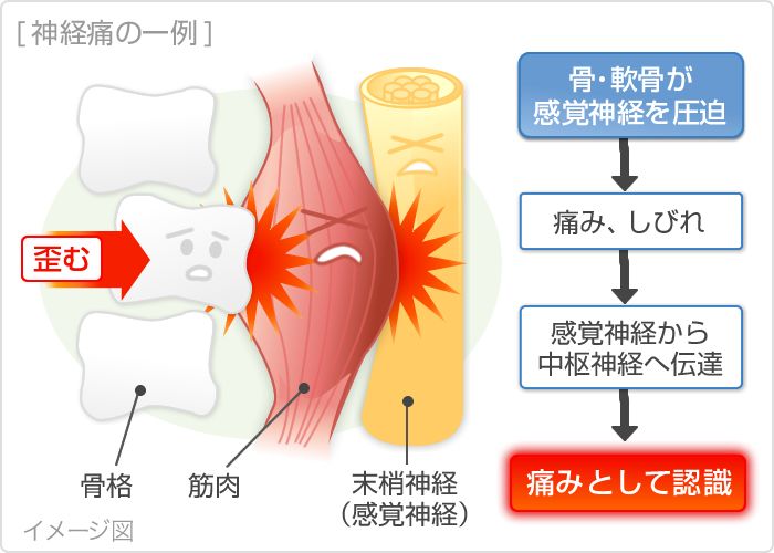 神経痛