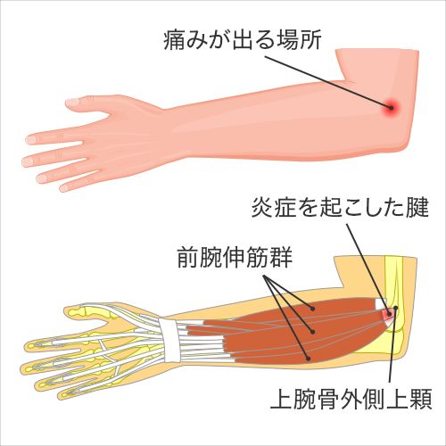 腕の炎症