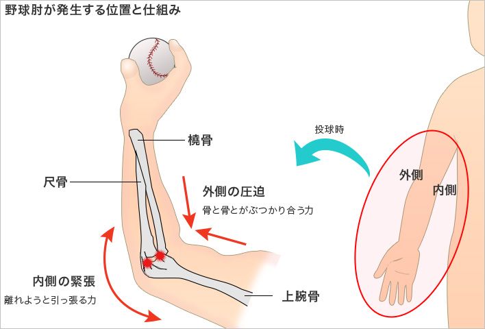 野球肘