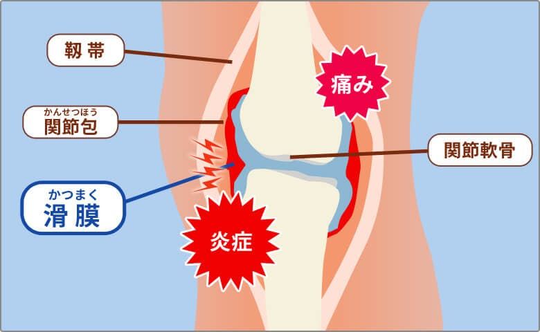 関節痛