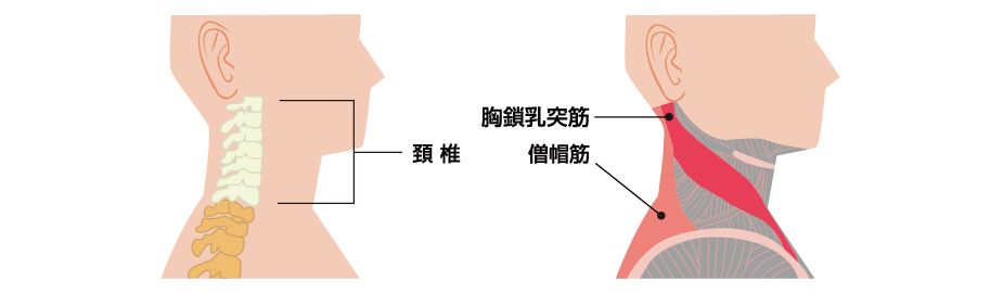 首の激痛