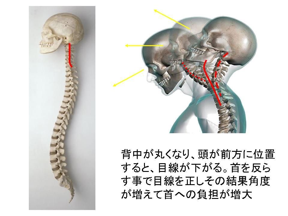 首の痛みと頭痛