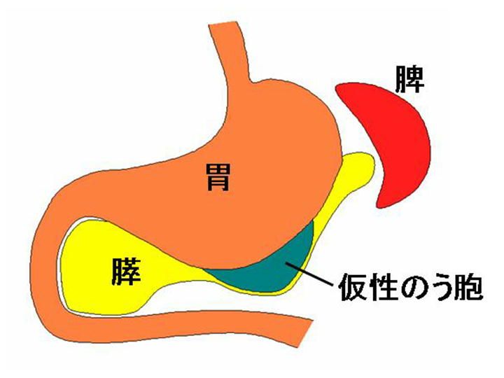 のう胞