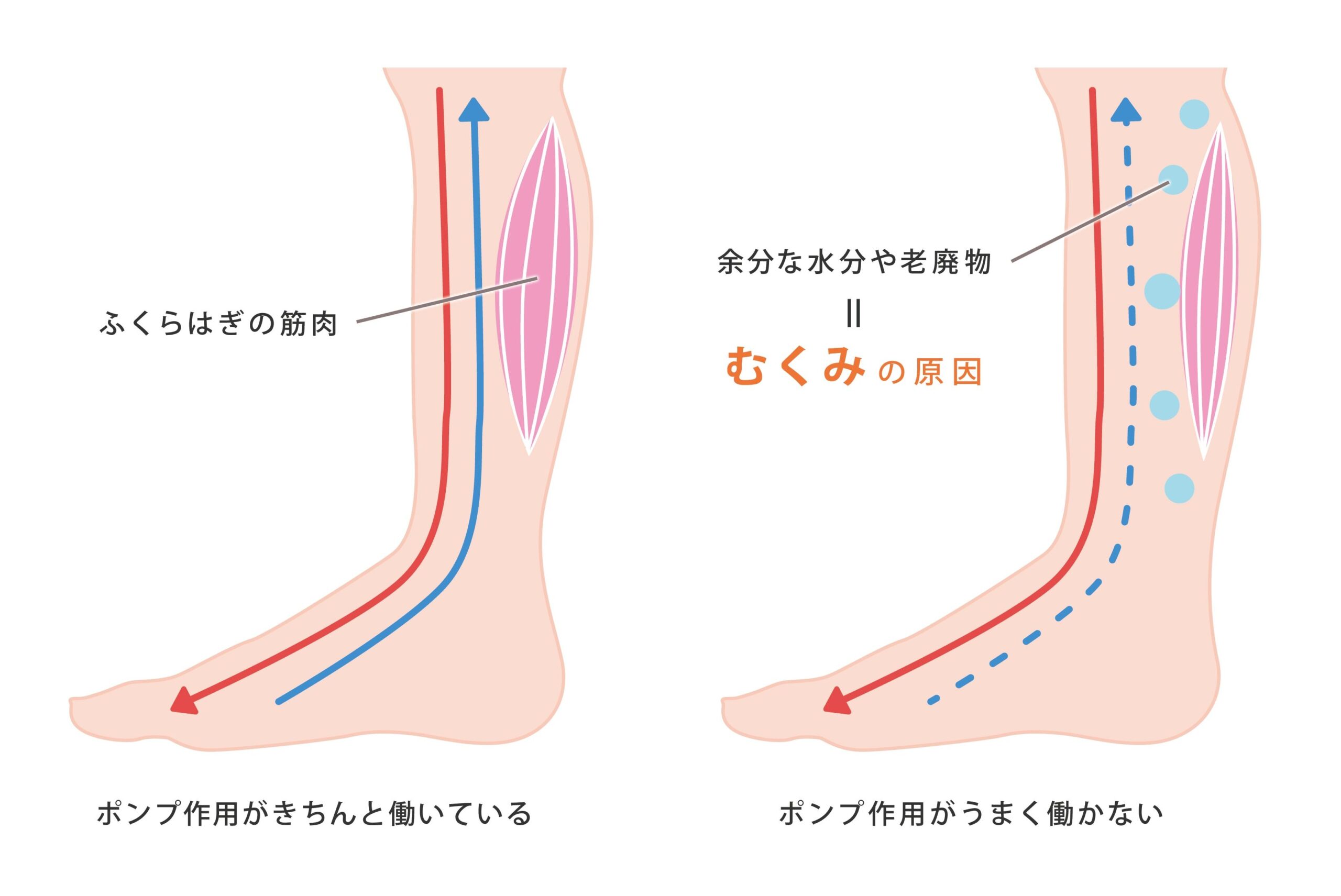 むくみ