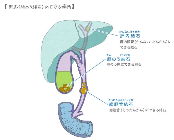 胆嚢