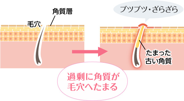 肌 ブツブツ 毛穴